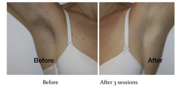 Before & After Pink Intimate System