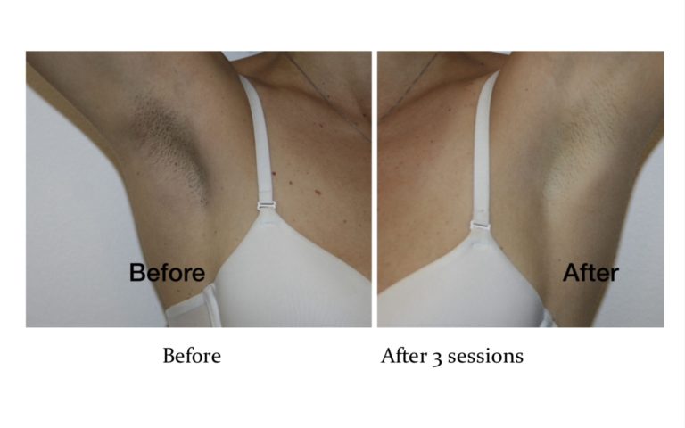 Before & After Pink Intimate System LMC - Laser Medical Clinic.
